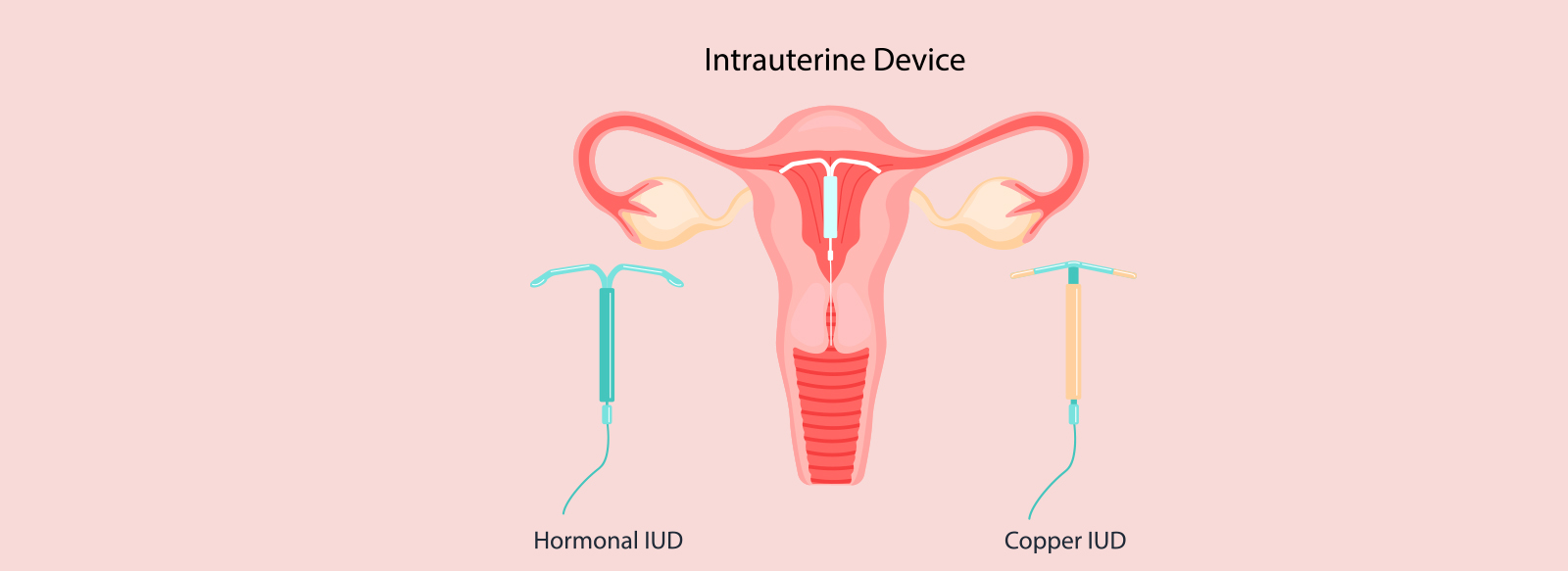 Intrauterine device Hormonal IUD Copper IUD